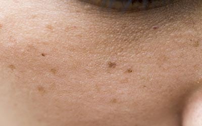 Dark Spot Skin